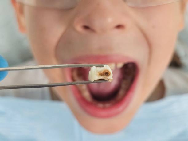 Best Emergency Tooth Extraction in St Paul, VA